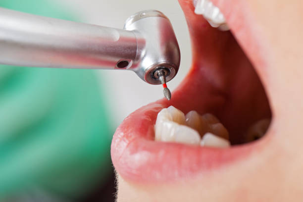 Best Broken or Cracked Tooth Emergency Dentist in Bay Minette, AL